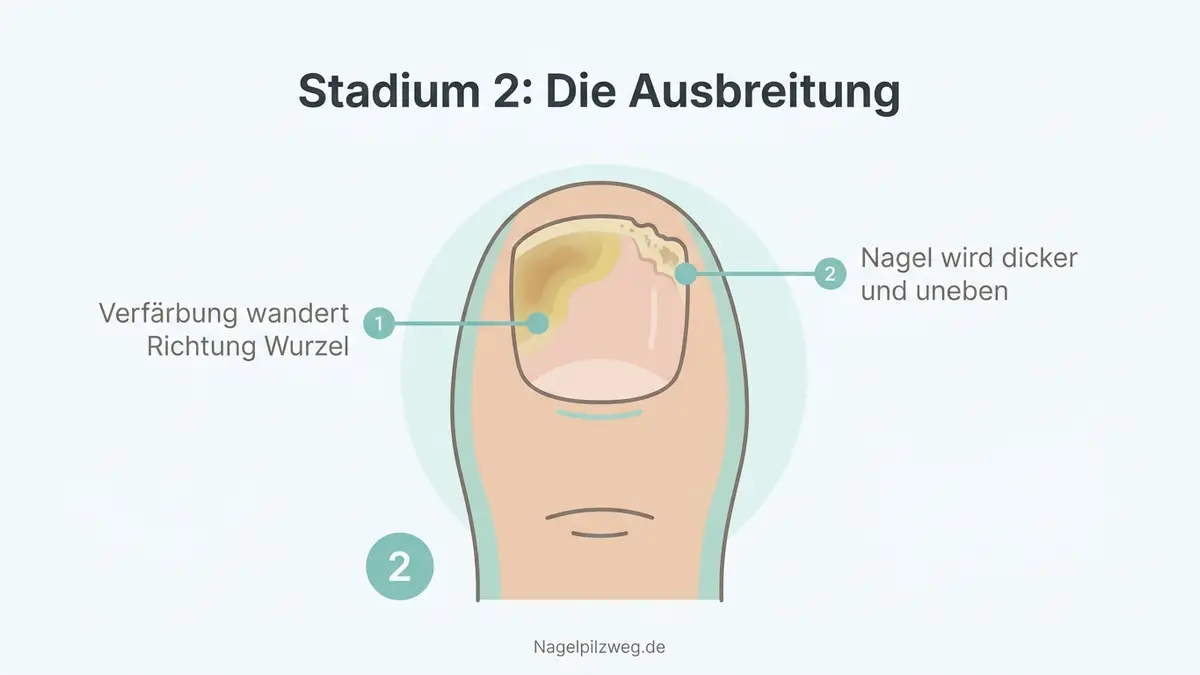 Illustration: mittleres Stadium mit ausgedehnter Verfärbung und Verdickung